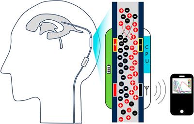 Frontiers A novel ventriculoperitoneal shunt flow sensor based